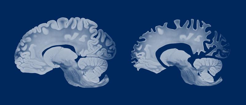 Warum bekommen Menschen mit Downsyndrom früh Alzheimer?