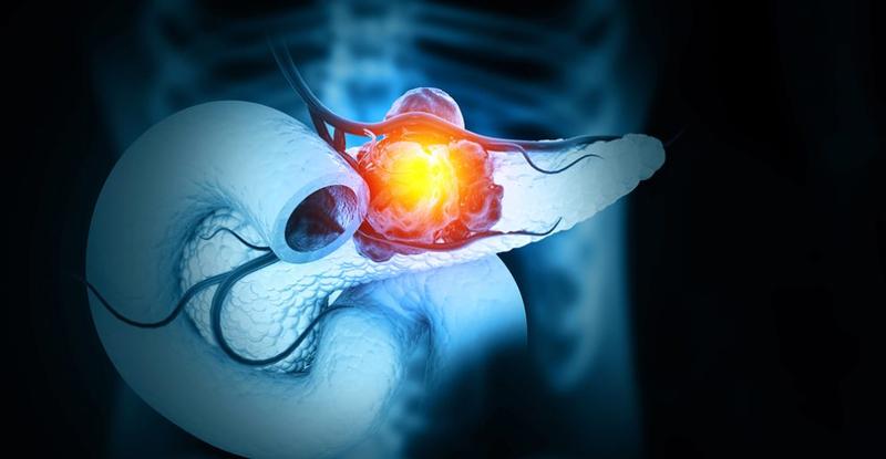 Bauchspeicheldrüsenkrebs: Neue Erkenntnisse über eine tödliche Krankheit